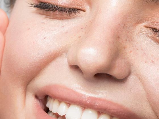 Close-up of a smiling person with closed eyes, showing clear skin, freckles, white teeth, and glossy lips.