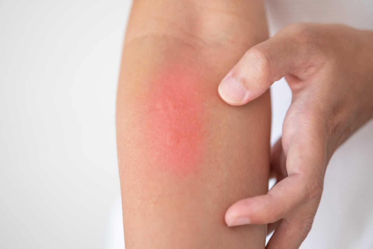 A person touching their forearm, which has a red, irritated patch of skin possibly indicating a rash, allergy, or irritation. The background is plain and light-colored.